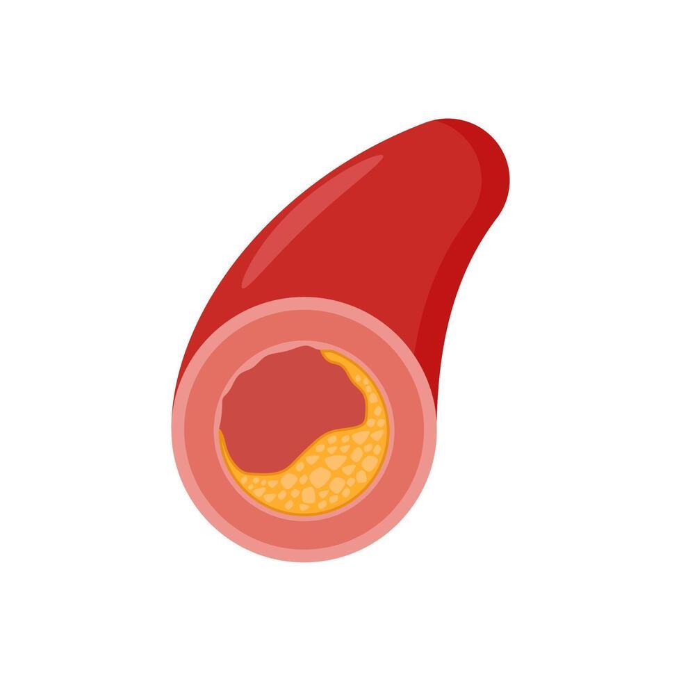 Atherosclerosis