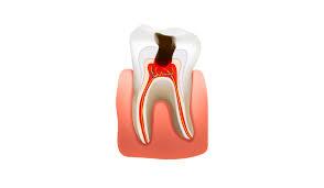 Tooth Abscesses