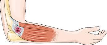 Tendinitis 