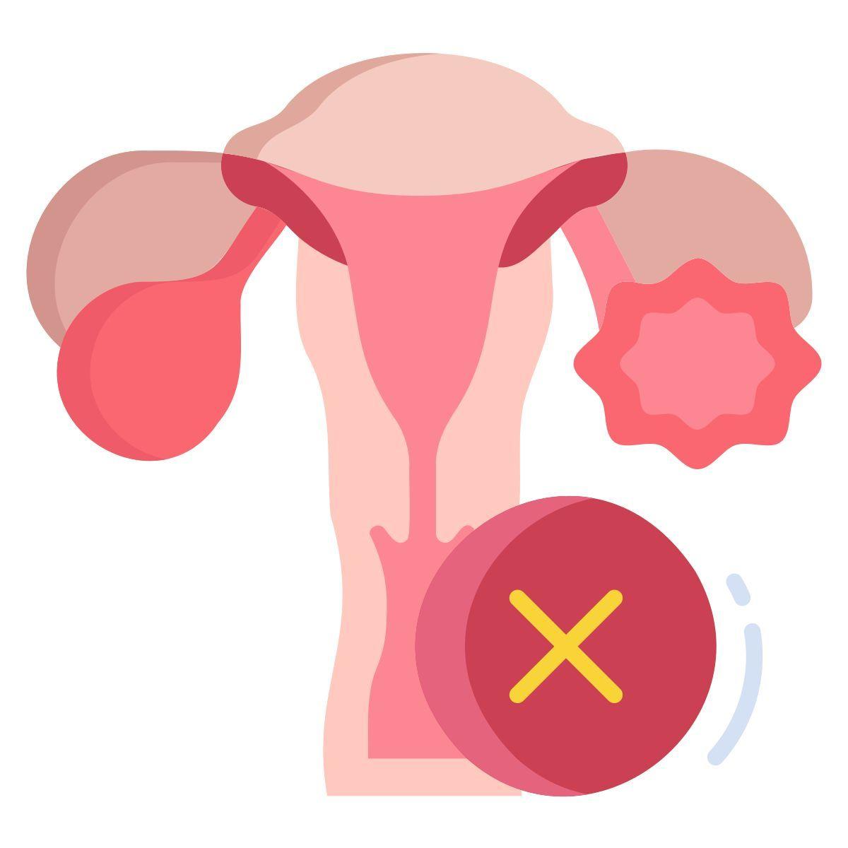 PCOS Diet