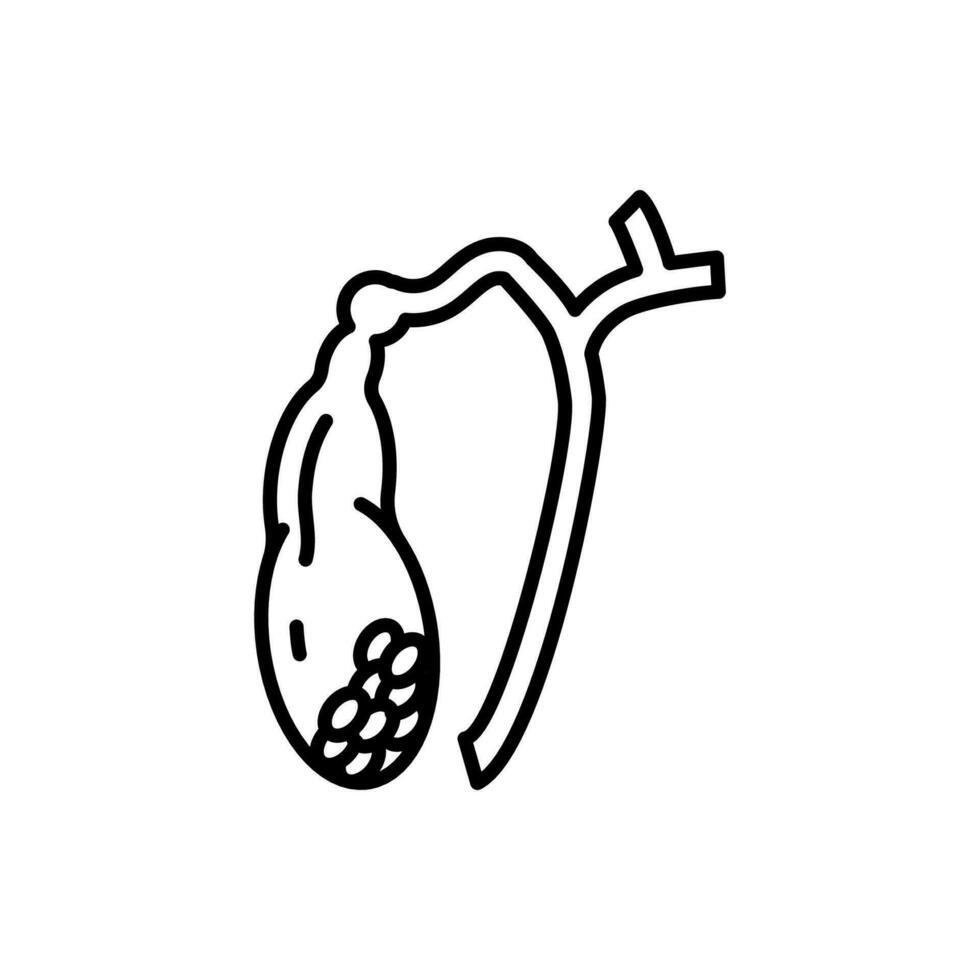Gallstones Surgery